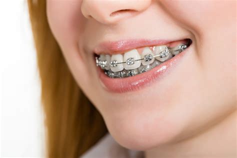 marcas de brackets metalicos|que tipo de brackets.